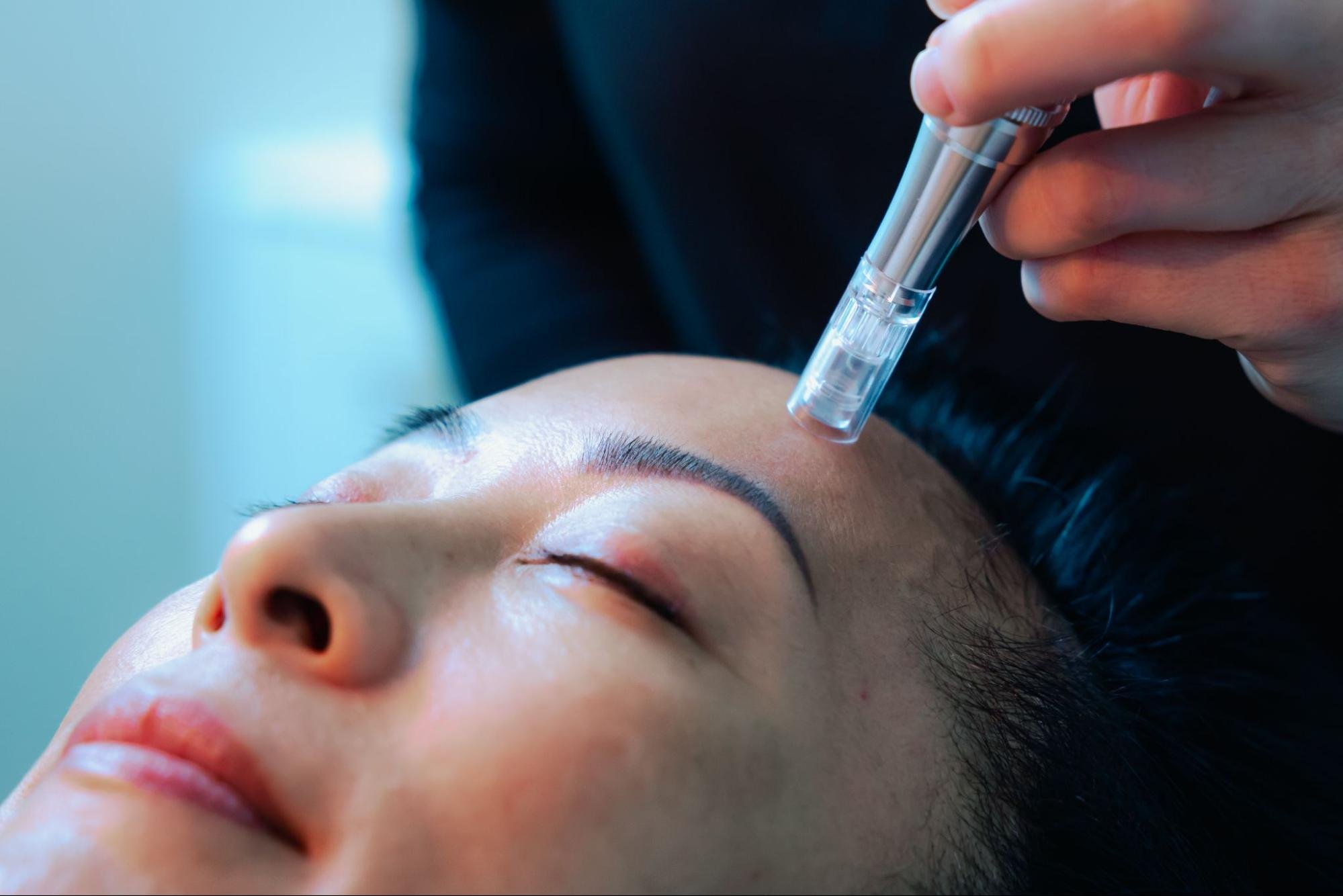 A medspa client receives microneedling treatment on her forehead.