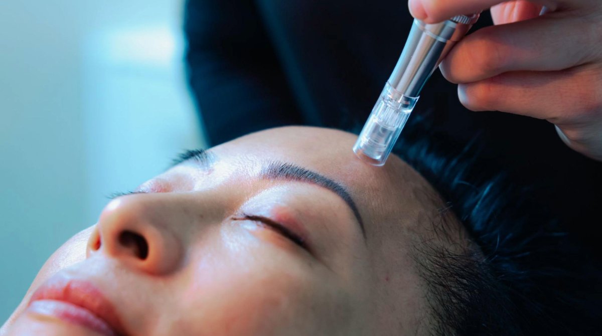 A medspa client receives microneedling treatment on her forehead.